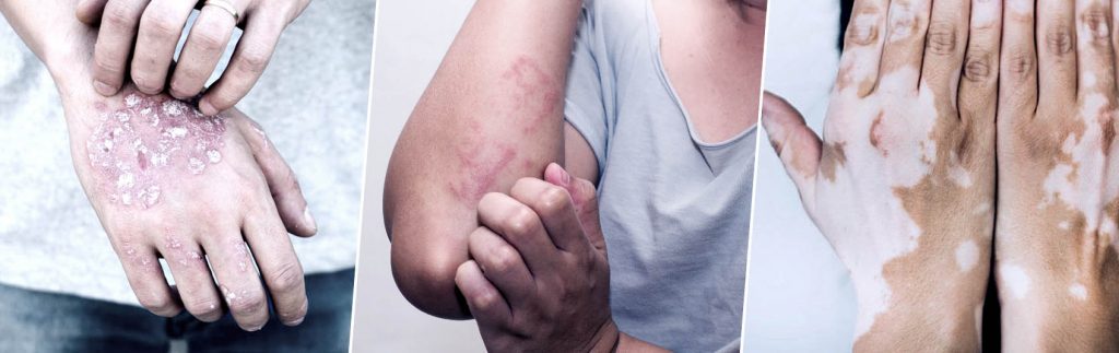 UVB Therapy for Skin Disease