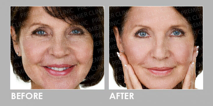 Before & After Radiessse Filler Injection
