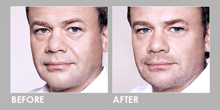 Before & After Radiessse Filler Injection