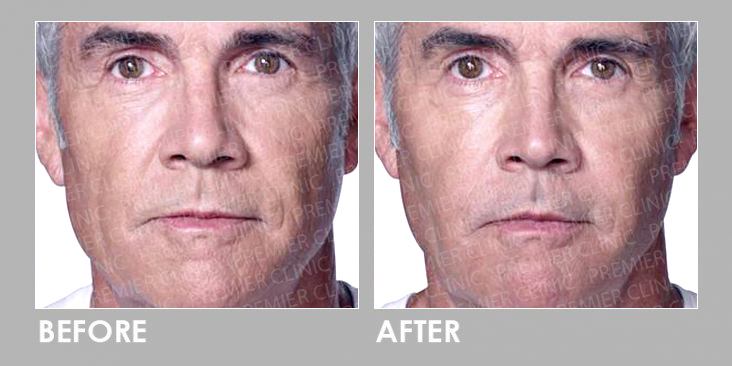 Before & After Radiessse Filler Injection