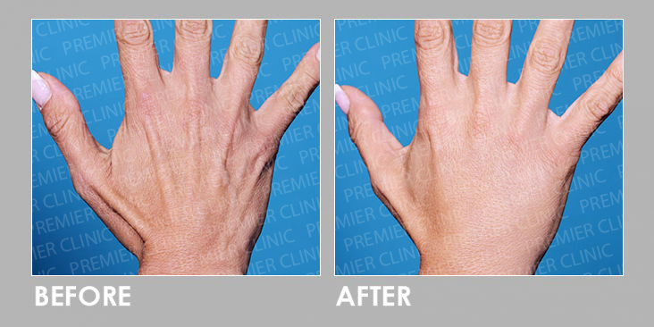 Before & After Injection
