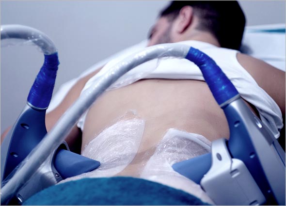 Benefits of Clatuu Fat Freezing Treatment
