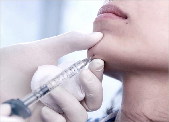 Benefits of Derma Filler Treatment