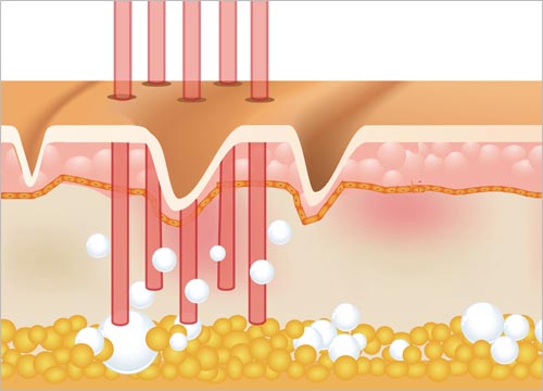 Benefits of Fractional CO2 Laser