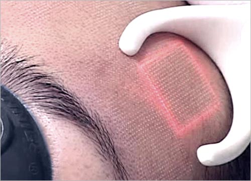 Benefits of Fractional CO2 Laser