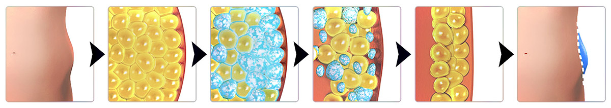 Benefits of Zeltiq CoolSculpting 02