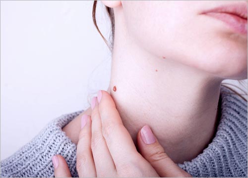 Birthmark