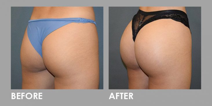 Before & After Buttock Injection Augmentation Procedure