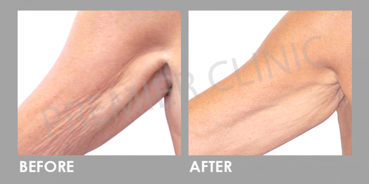 CANDELA-Before-After