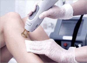 CANDELA GENTLE YAG LASER TREATMENT