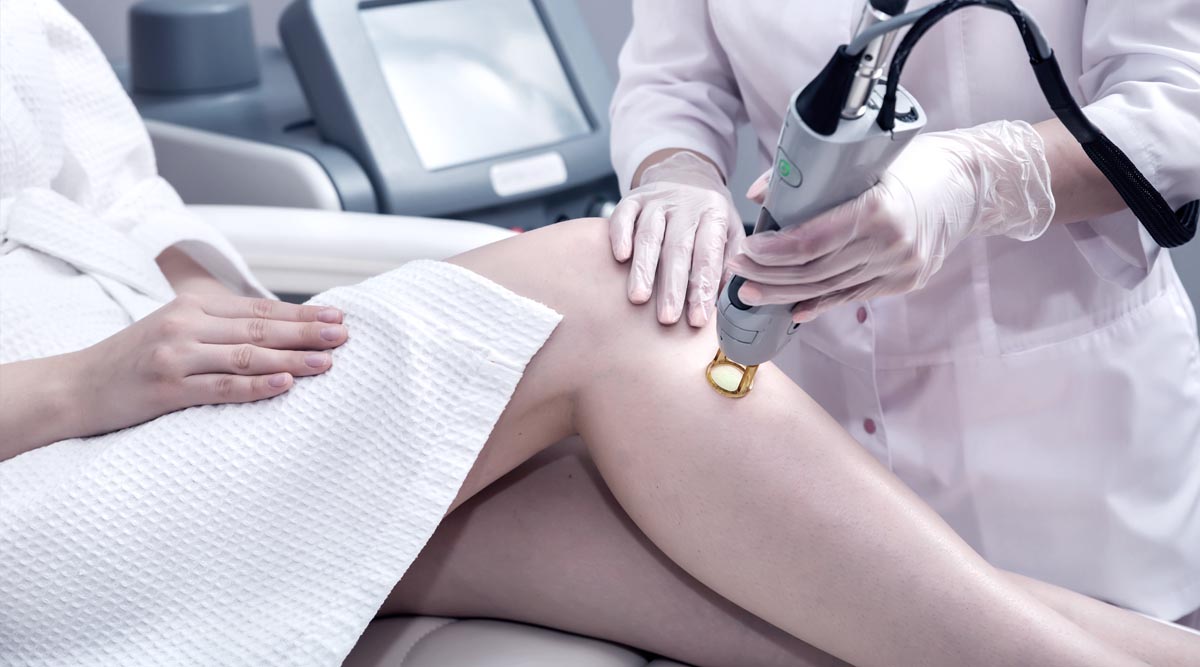 CANDELA GENTLE YAG LASER TREATMENT