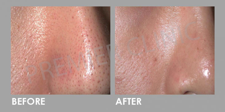 Before & After Carbon Laser Peel Treatment