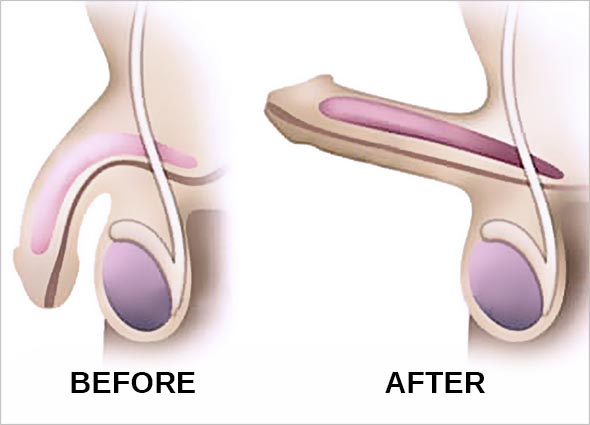 Caverject Injection for Erectile Dysfunction
