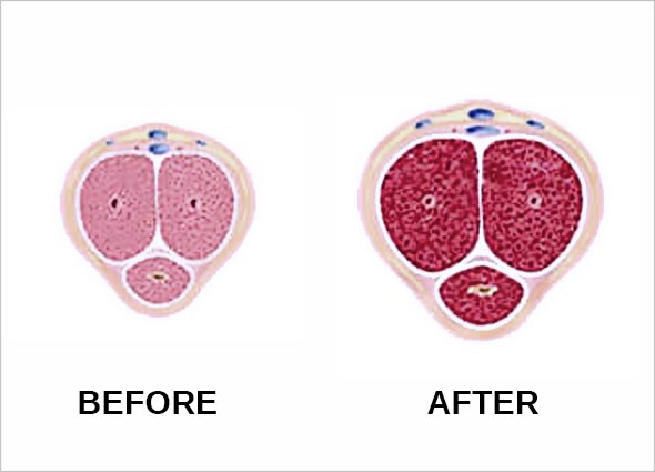 Caverject Injection for Erectile Dysfunction