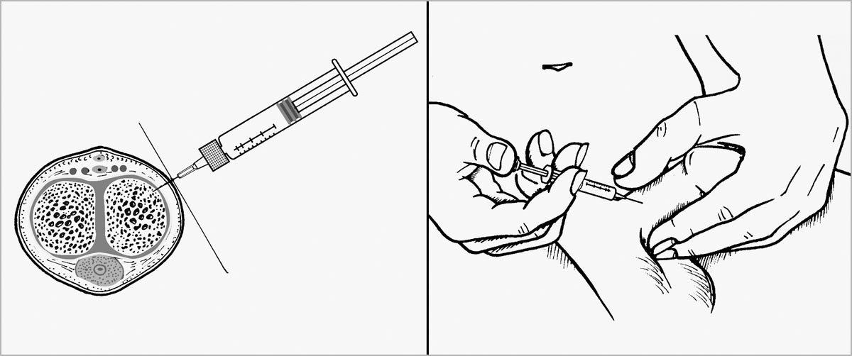 Caverject Injection for Erectile Dysfunction