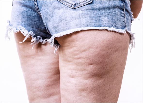 Cellulite