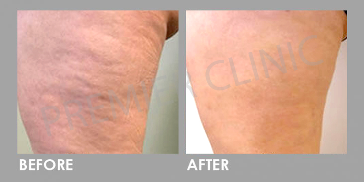 Cellulite-removal-Before-After