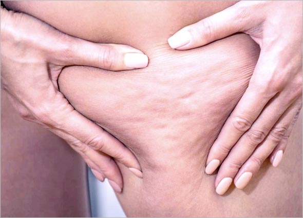 Cellulite