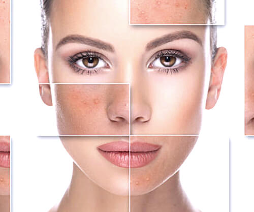 Chemical Peel