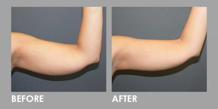 Before & After Clatuu Fat Freezing Treatment
