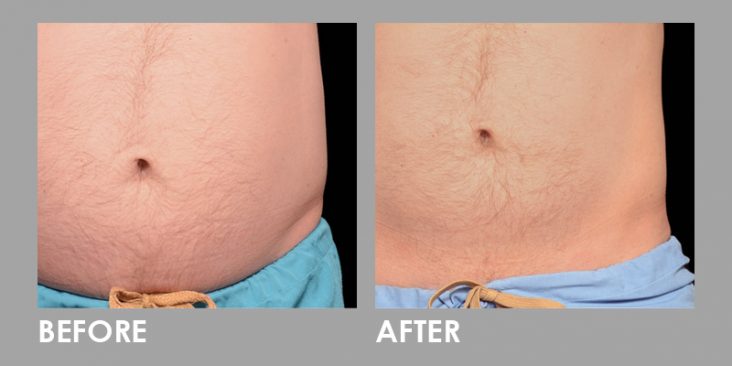 Before & After Clatuu Fat Freezing Treatment