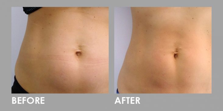Before & After Clatuu Fat Freezing Treatment