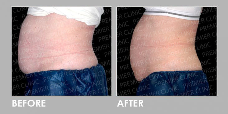 CoolSclupting Before & After