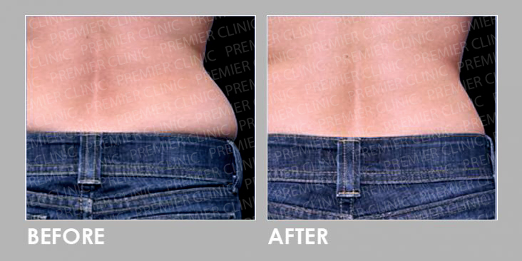 CoolSclupting Before & After