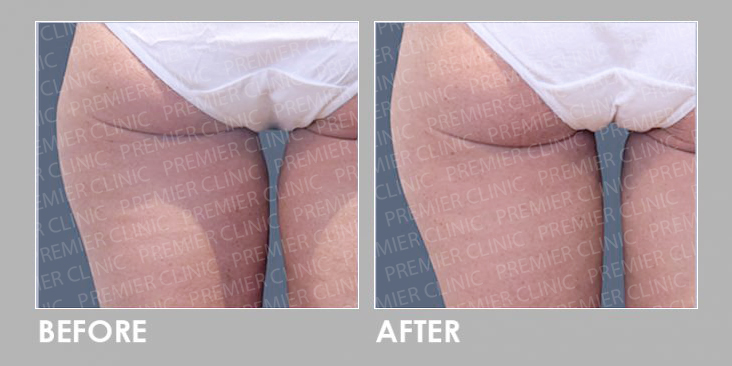 CoolSclupting Before & After