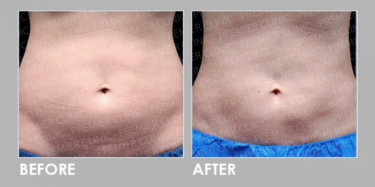 CoolSclupting Before & After