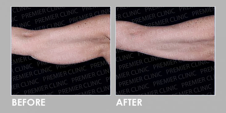 CoolSclupting Before & After