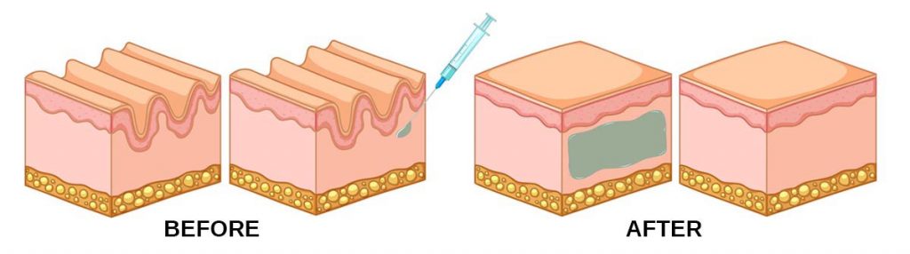 DERMA FILLER WORK