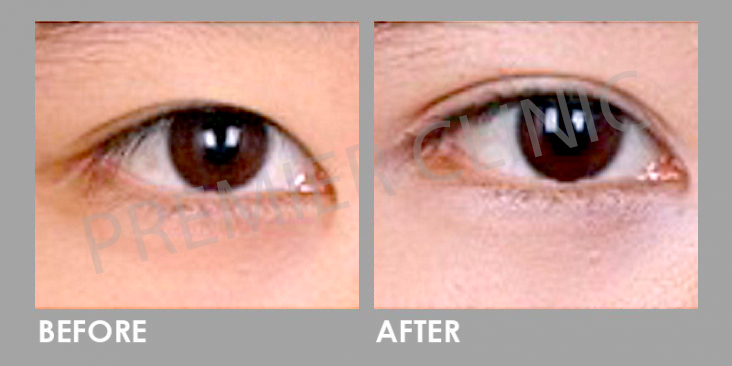 Before & After Double Eyelid Stitching