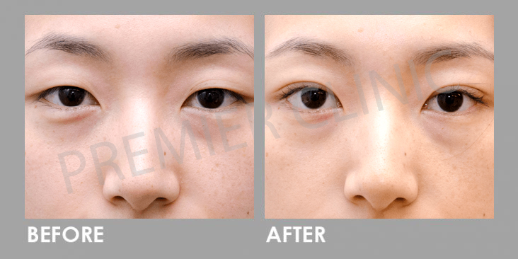 Before & After Double Eyelid Stitching