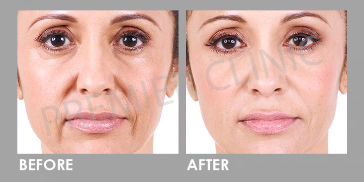 Before & After Dermal Filler Treatment