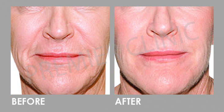 Before & After Dermal Filler Treatment