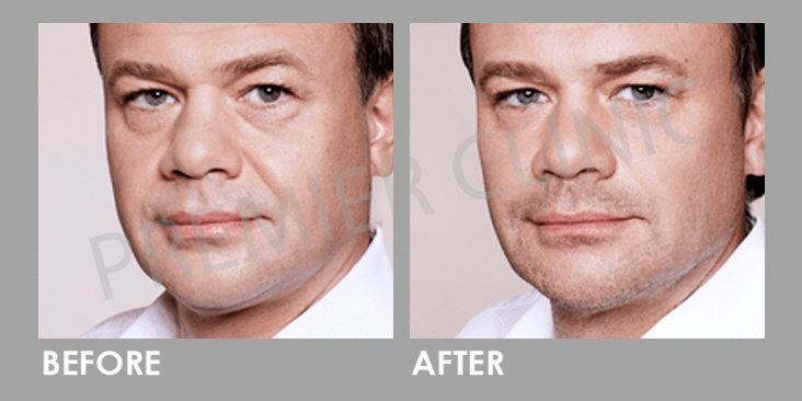 Before & After Dermal Filler Treatment