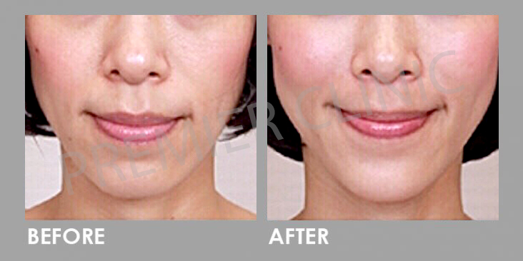 Before & After Sculptra