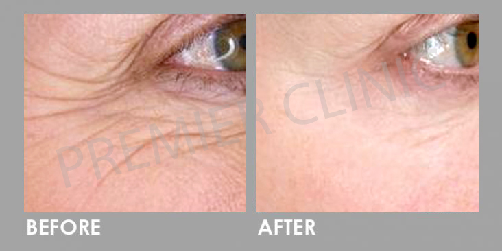 Before & After