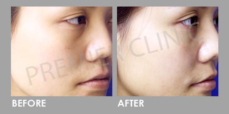 Comparing results of Derma Veil injection at Premier Clinic, Malaysia