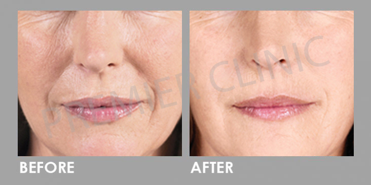 Before & After Sculptra