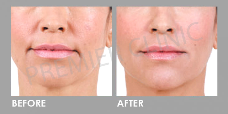 Before & After Sculptra