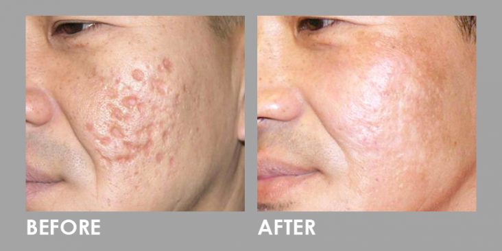 Before & After Dermaroller (Microneedling)