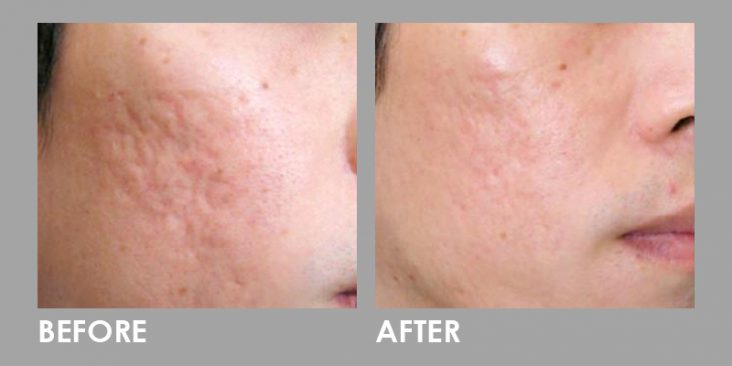 Before & After Dermaroller (Microneedling)