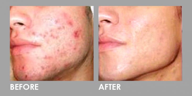 Before & After Dermaroller (Microneedling)