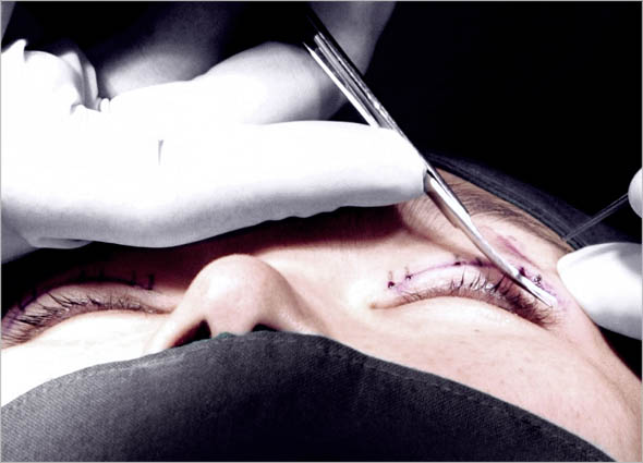 Double Eyelid Non-Invasive Surgery