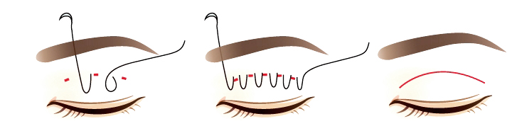 Double Eyelid Non-Invasive Surgery