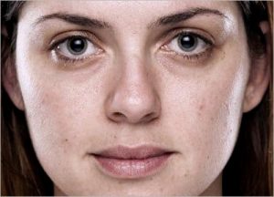 Dull skin
