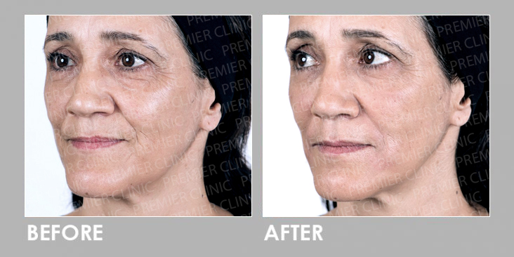 ELLANSE DERMAL FILLER Before After