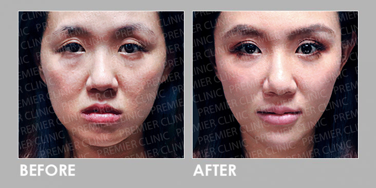 ELLANSE DERMAL FILLER Before After
